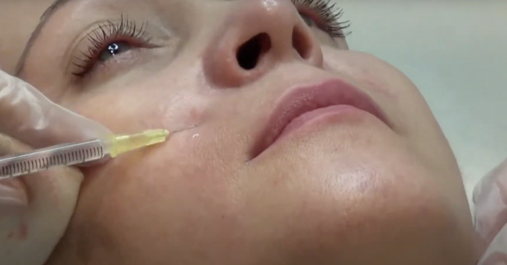 Facial Mesotherapy