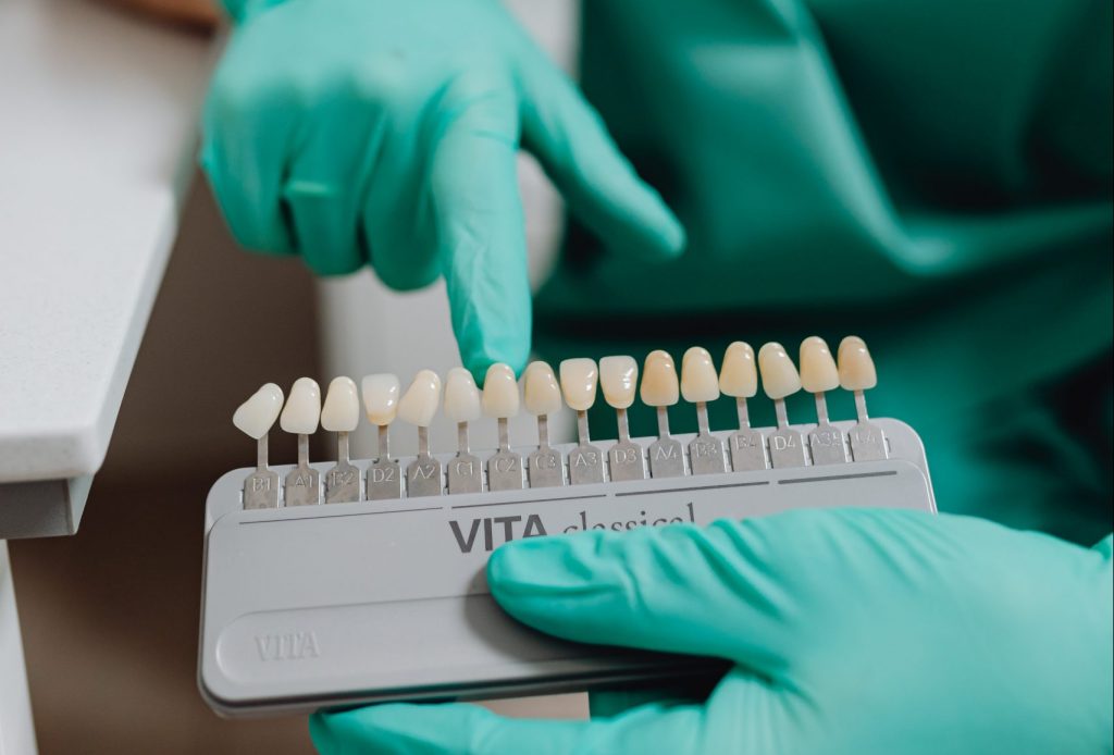 ceramic veneers