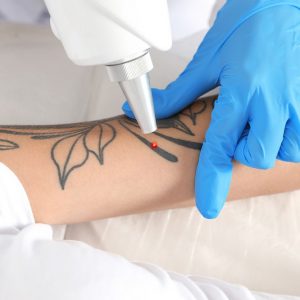 eliminación tatuajes