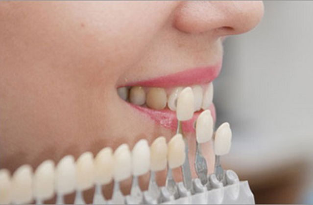 carillas de porcelana